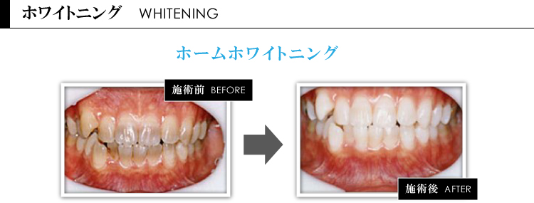 ホワイトニング